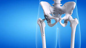 Hip replacement surgery in Narmadapuram