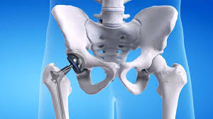 Hip replacement surgery in Pithampur