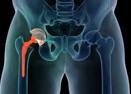 Hip replacement surgery in Umaria