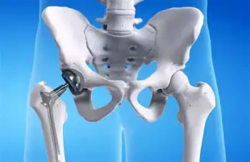 Hip replacement surgery in adilabad