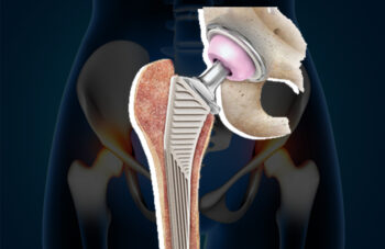 Hip replacement surgery in gadchiroli