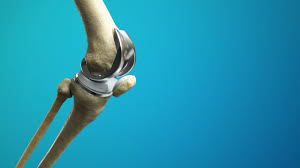 Knee Replacement Surgery In Betul