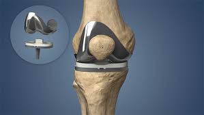 Knee Replacement Surgery In Itarsi
