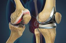 Knee Replacement Surgery In Tikamgarh