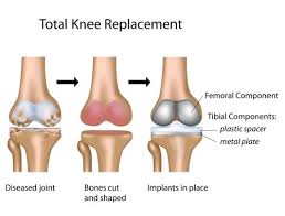 Knee Replacement Surgery In Umaria