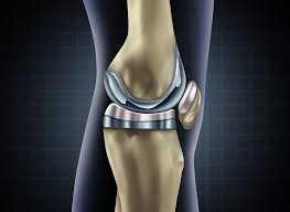 Knee Replacement Surgery in Sakti