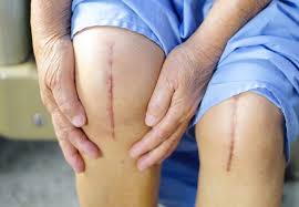Knee Replacement Surgery in Sarangarh-Bilaigarh