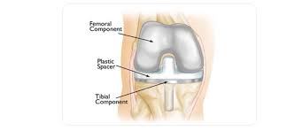 Knee Replacement Surgery in Sukma