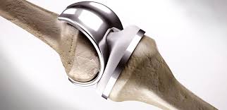 Knee Replacement Surgery in Surajpur