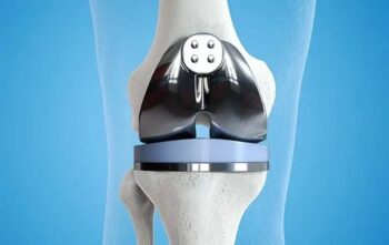 Knee replacement surgery in buldhana