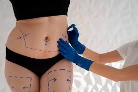 Liposuction in Betul