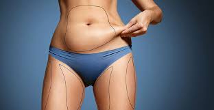 Liposuction in Mandsaur