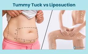Liposuction in Raigarh