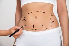 Liposuction in Surajpur