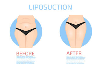 Liposuction in adilabad