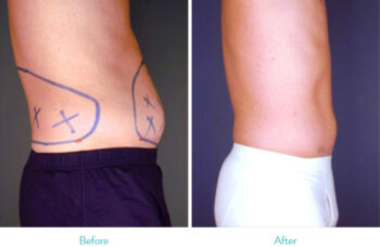 Liposuction in bhandara