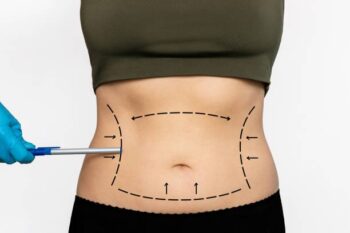 Liposuction in buldhana