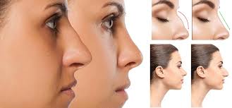 Rhinoplasty In Narsinghpur