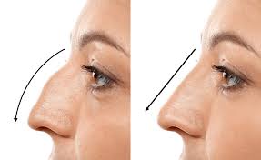 Rhinoplasty In Neemach