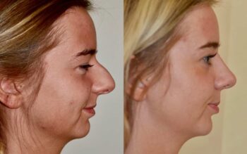 Rhinoplasty in Adilabad