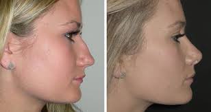 Rhinoplasty in Rajnandgaon