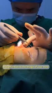 Rhinoplasty in Sarangarh-Bilaigarh