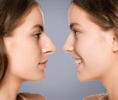 Rhinoplasty in Surajpur