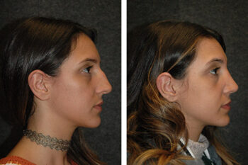 Rhinoplasty in bhandara