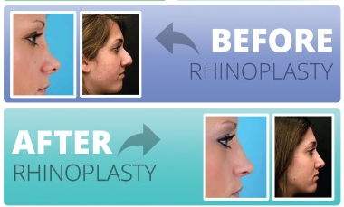 Rhinoplasty in gadchiroli