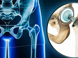 Robotic Hip Replacement in Korea
