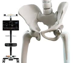 Robotic Hip Replacement in Narayanpur