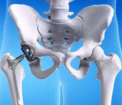 Robotic Hip Replacement in Raigarh