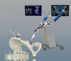Robotic Hip Replacement in Sukma