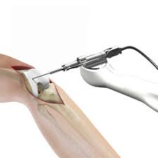 Robotic Joint Replacement in Sukma