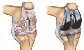 Robotic Knee Replacement in Narayanpur