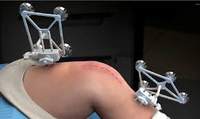 Robotic Knee Replacement in Sakti