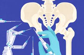 Robotic hip replacement in Narsinghpur