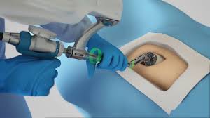 Robotic hip replacement in Umaria
