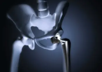 Robotic hip replacement in bhandara