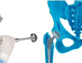 Robotic hip replacement in washim