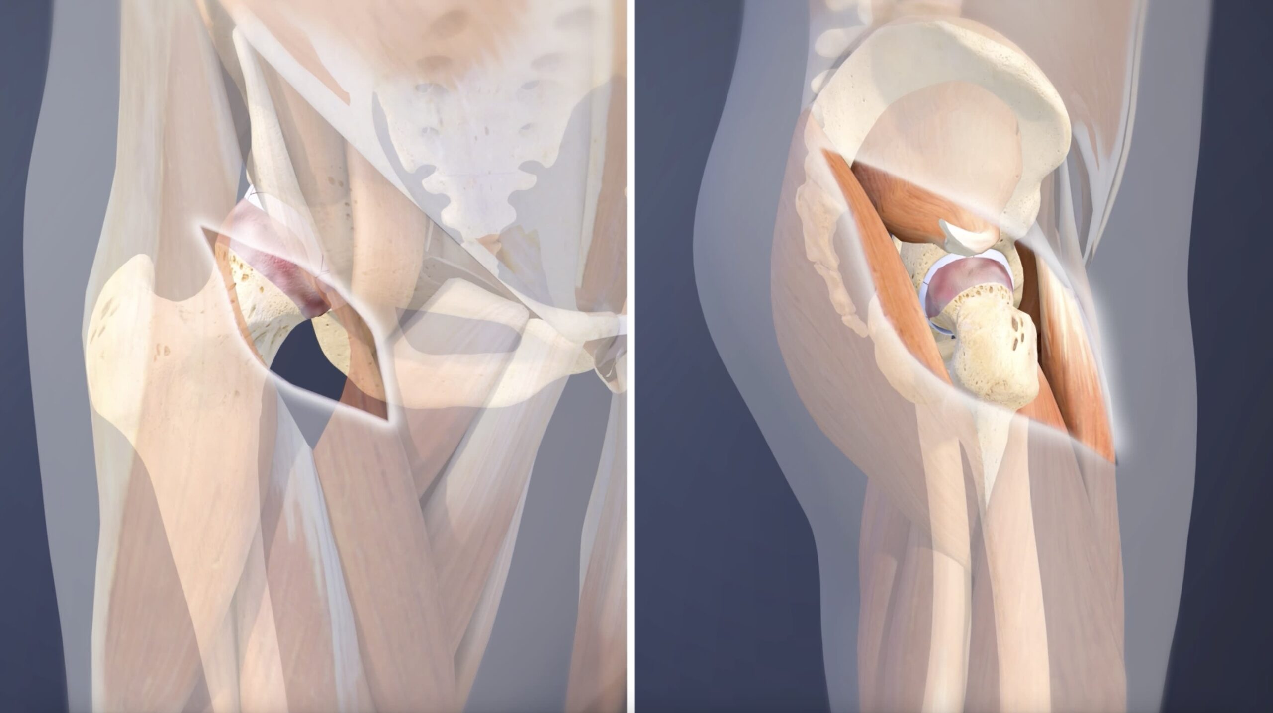 Minimally invasive joint replacement in Nagpur