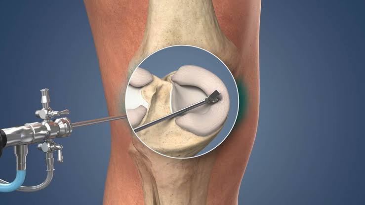 Arthroscopic injury solutions in Nagpur