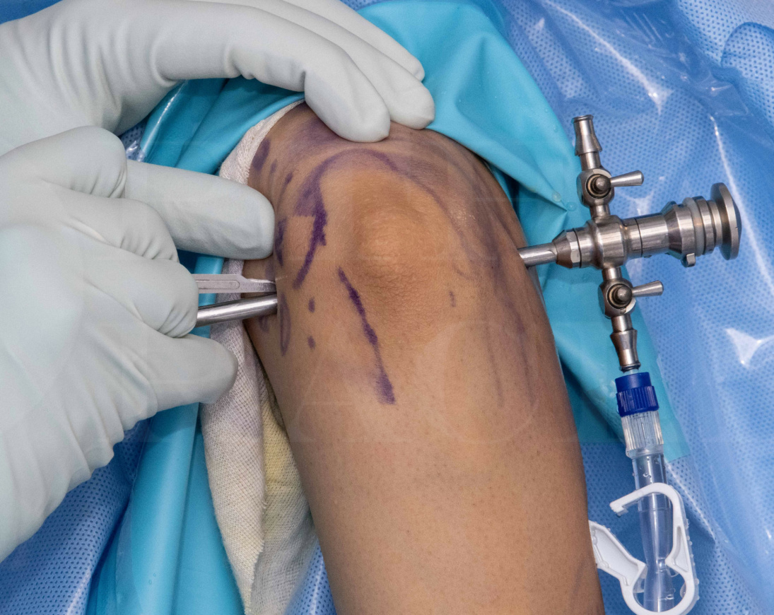 Arthroscopy Centre In Nagpur