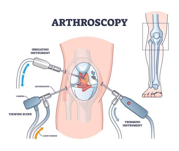 Arthroscopy Surgeon In Nagpur