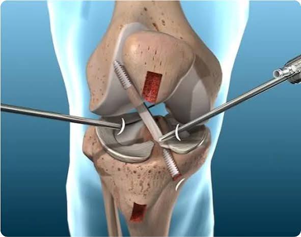 Best Knee Ligament Surgeon In Balaghat