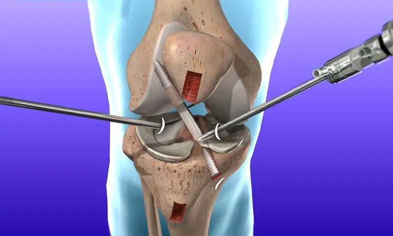 Best Knee Ligament Surgeon in Seoni