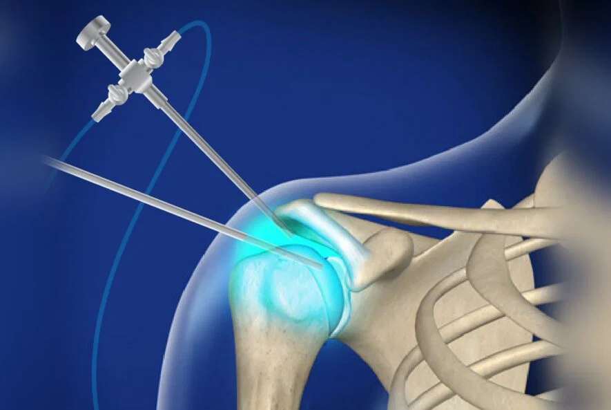 Best Shoulder Surgeon In Balaghat