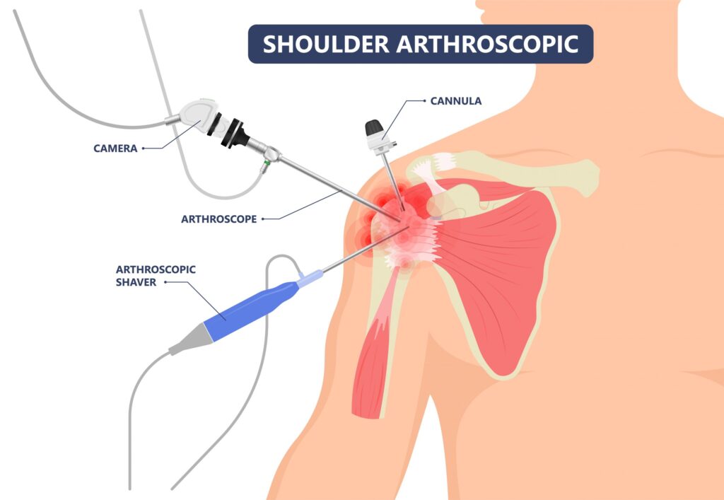 Best Shoulder Surgeon In Gondia