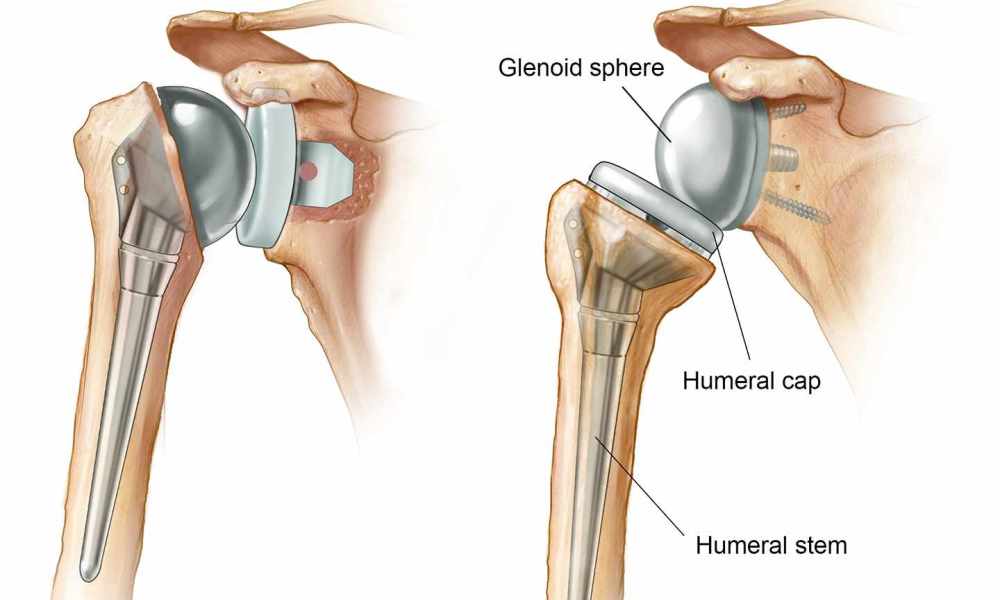 Best Shoulder Surgeon In Rewa
