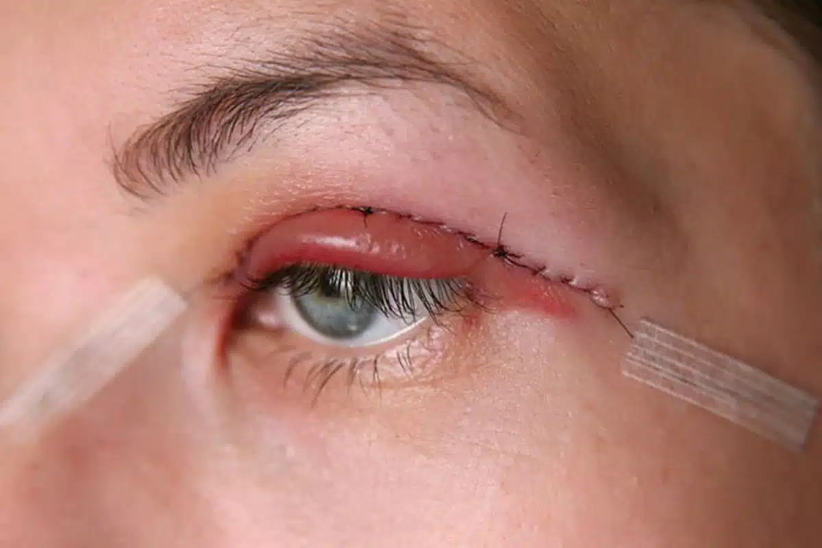 Blepharoplasty in nagpur